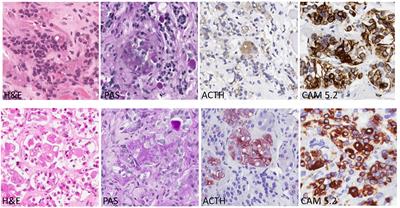 Significance of Crooke's Hyaline Change in Nontumorous Corticotrophs of Patients With Cushing Disease